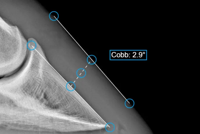 Cobb angle measurement